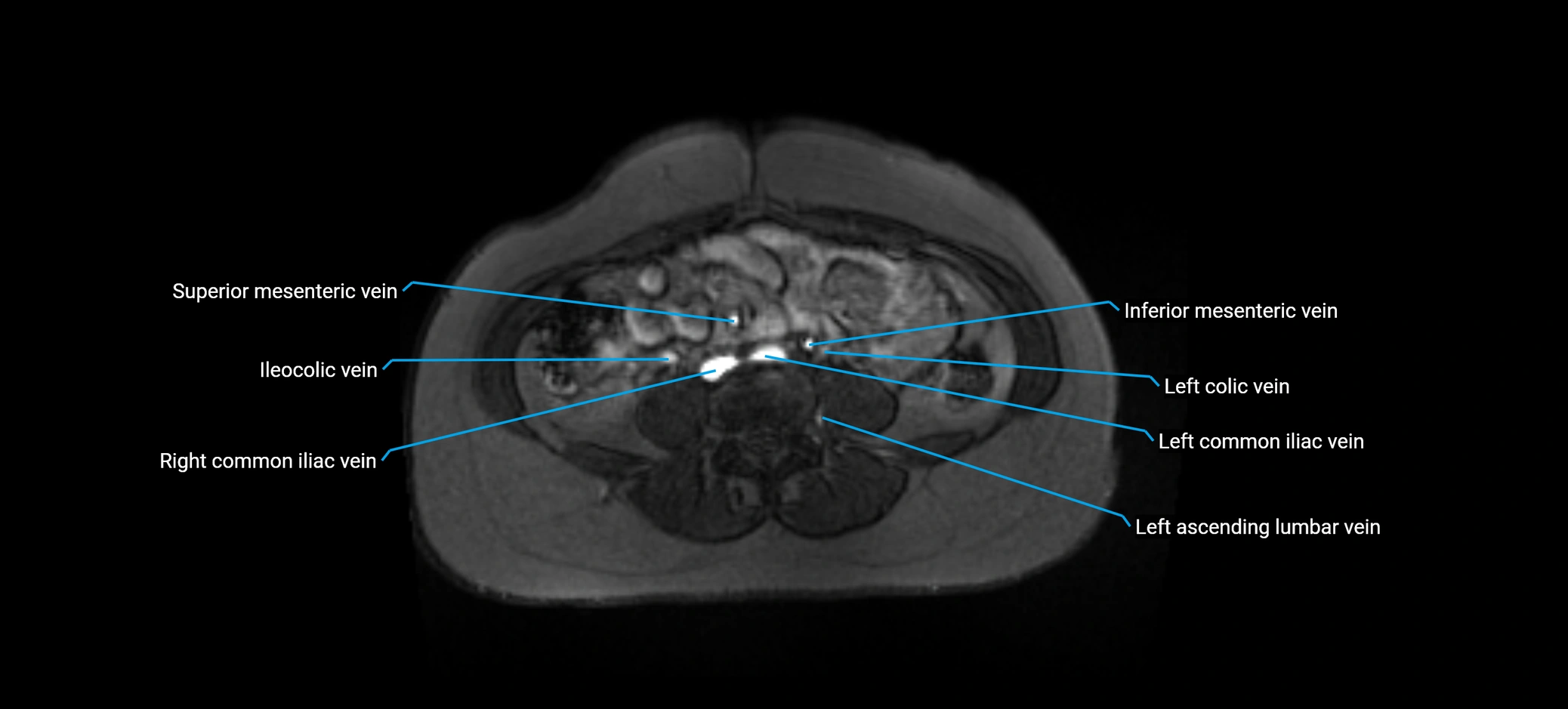 MRV abdomen pelvis & lower limb axial cross sectional anatomy labelled MRI image 114 (1).webp